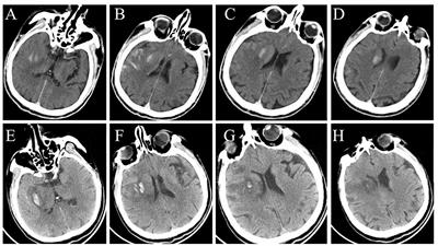 Post-ASPECTS based on hyperdensity in NCCT immediately after thrombectomy is an ultra-early predictor of hemorrhagic transformation and prognosis